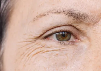 Marcas post-inflamatorias y líneas alrededor del ojo tras brotes de acné