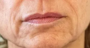 Comparación antes y después del uso de Glowy Care en zona de boca y mejillas (antes)
