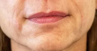 Comparación antes y después del uso de Glowy Care en zona de boca y mejillas (después)