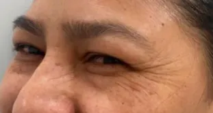 Antes y después de Glowy Care en el tratamiento del paño en mejillas (antes)