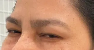 Antes y después de Glowy Care en el tratamiento del paño en mejillas (después)