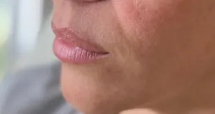 Resultados de Glowy Care en pliegues alrededor de la boca, antes y después (antes)
