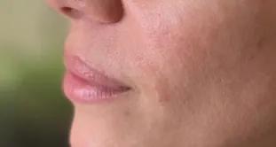 Resultados de Glowy Care en pliegues alrededor de la boca, antes y después (después)