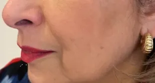Antes y después del uso diario de Glowy Care en piel seca con manchas (antes)