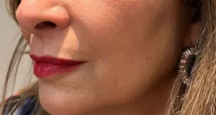 Antes y después del uso diario de Glowy Care en piel seca con manchas (después)