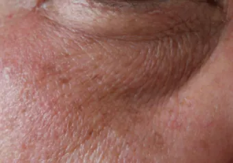 Paño o melasma: mancha café difusa en el cachete de una mujer