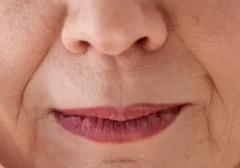 Pliegues nasolabiales y líneas de expresión marcadas alrededor de la boca